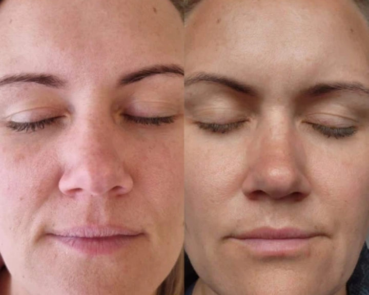 SQT-Bio-Microneedling-image