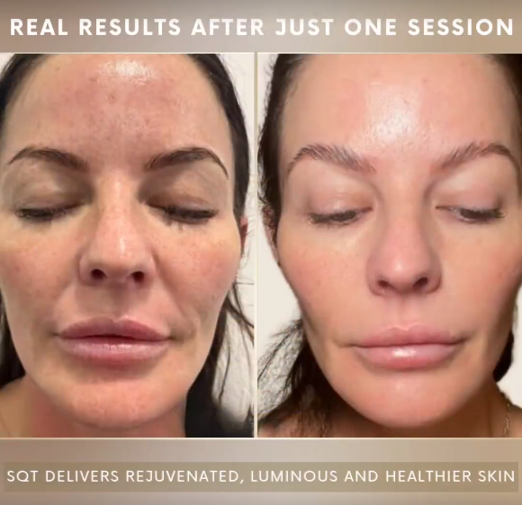 Is SQT Bio-Microneedling Expensive? Here’s a Breakdown of Pricing & Packages