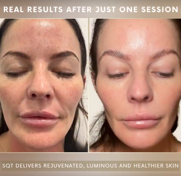 Is SQT Bio-Microneedling Expensive? Here’s a Breakdown of Pricing & Packages