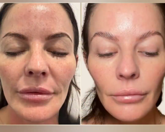 Is SQT Bio-Microneedling Expensive? Here’s a Breakdown of Pricing & Packages